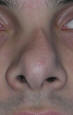 Rhinoplasty Beverly Hills