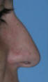 Rhinoplasty Los Angeles