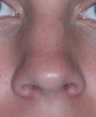 Rhinoplasty Los Angeles