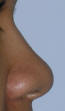 Rhinoplasty San Diego