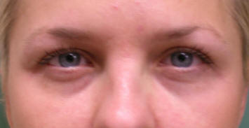 Los Angeles Blepharoplasty