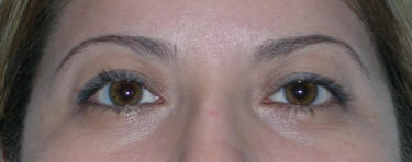Beverly Hills Eyelid Surgery