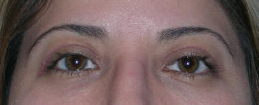 Beverly Hills Eyelid Surgery