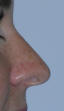 Rhinoplasty Beverly Hills