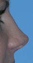 Rhinoplasty Beverly Hills