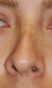 Rhinoplasty San Diego
