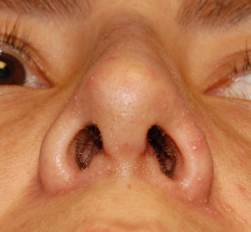 Rhinoplasty Beverly Hills