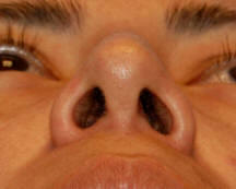 Los Angeles Nose Surgery