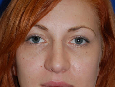 Beverly Hills Eyelid Surgery