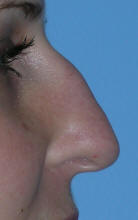 Beverly Hills Eyelid Surgery