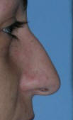 Los Angeles Nose Surgery