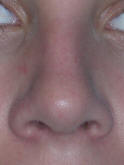 Rhinoplasty San Diego
