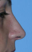 Rhinoplasty Beverly Hills