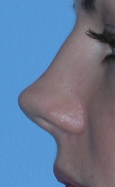Rhinoplasty Beverly Hills