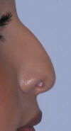 Beverly Hills Eyelid Surgery