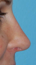 Los Angeles Nose Surgery