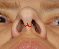 Rhinoplasty San Diego