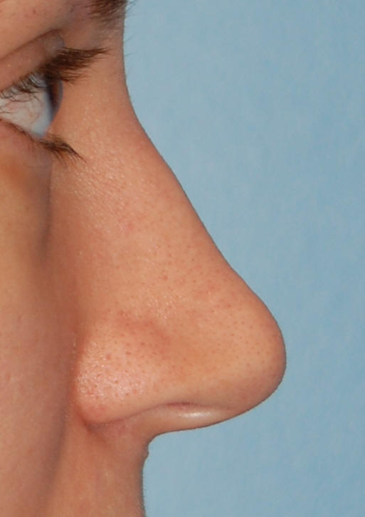 Rhinoplasty San Diego
