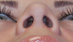 Los Angeles Blepharoplasty
