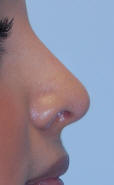 Rhinoplasty San Diego