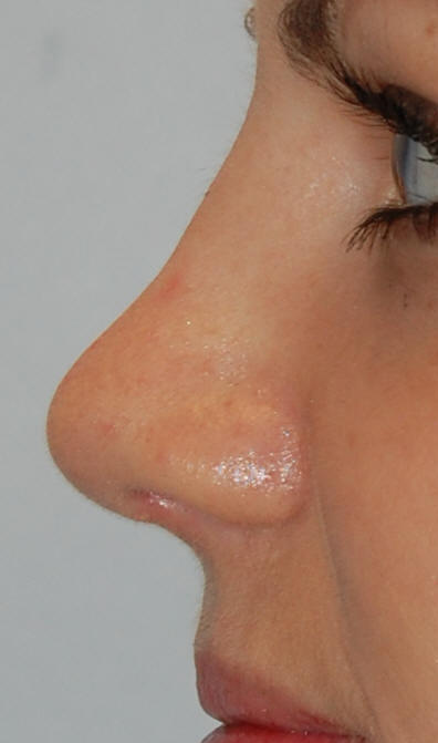 Rhinoplasty Beverly Hills