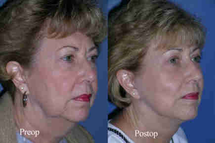 Beverly Hills Blepharoplasty