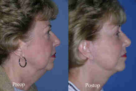 Beverly Hills Facelift